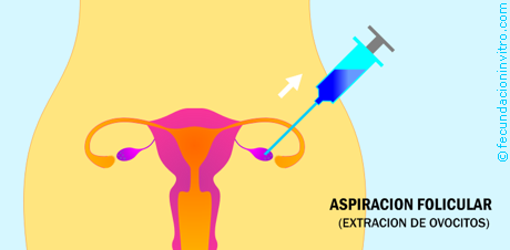 Extraccion de Ovocitos