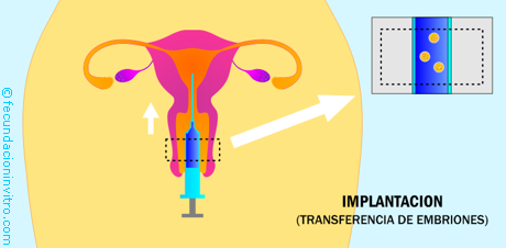 Transferencia de Embriones